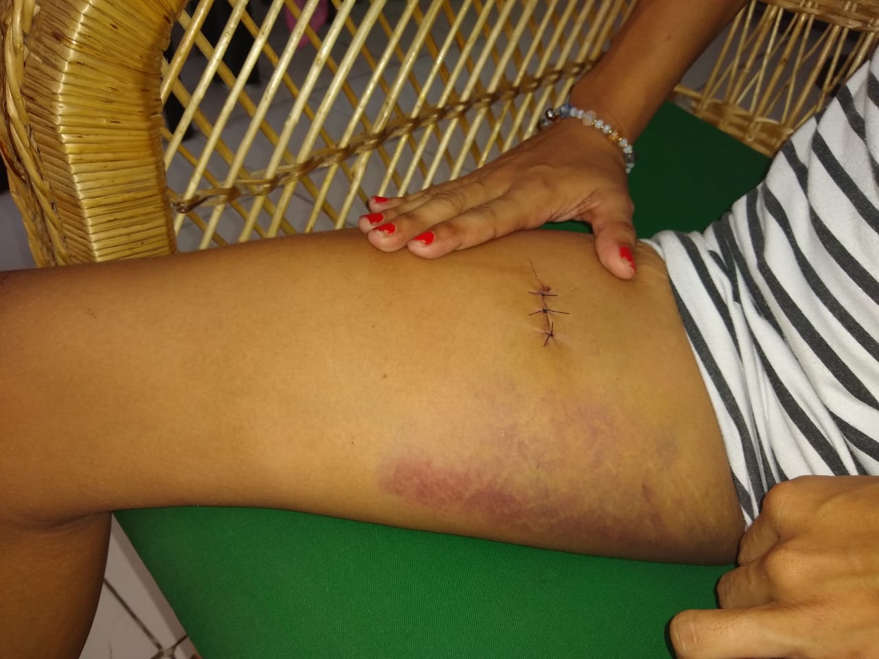 Heridas de Maryuris Correa Jiménez.
