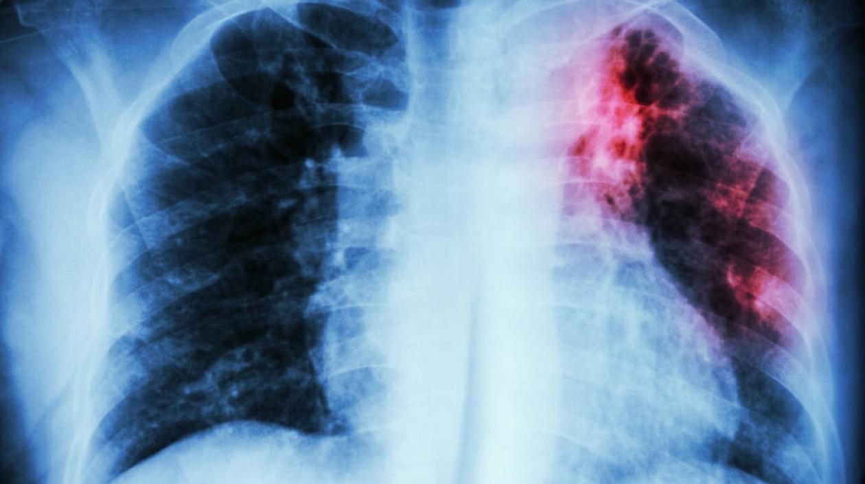 La fibrosis pulmonar hace que el tejido del pulmón desarrolle cicatrices.