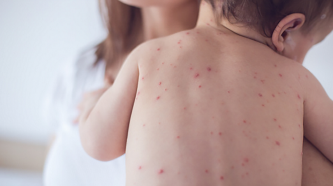 Los niños están más expuestos al contagio de la varicela.