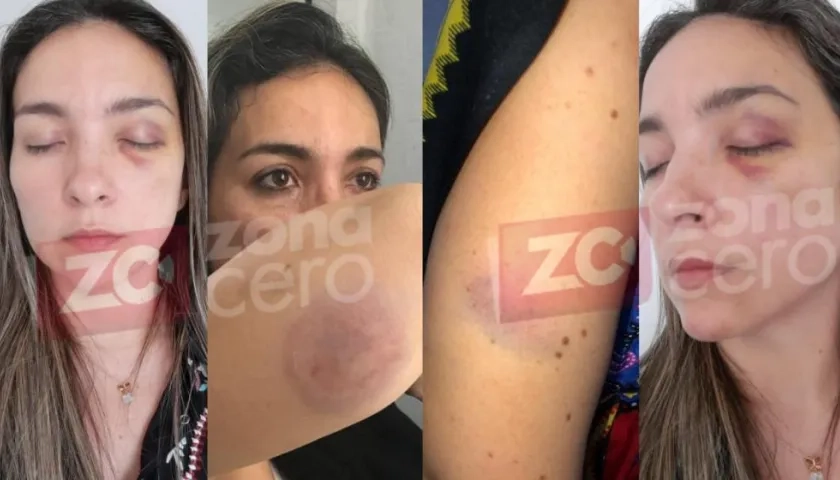 Las lesiones que sufrió Laura Isabel Navas Jaramillo.