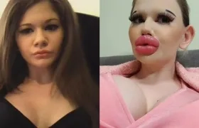Andrea Ivanova en una foto de antes y después de los procedimientos para engrosar sus labios.